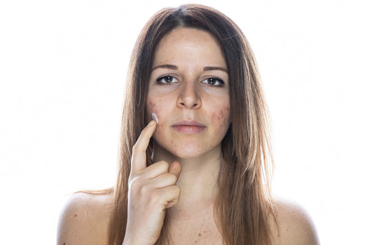 Rougeurs, irritations, micro-lésions : comment aider la peau à se réparer rapidement ?
